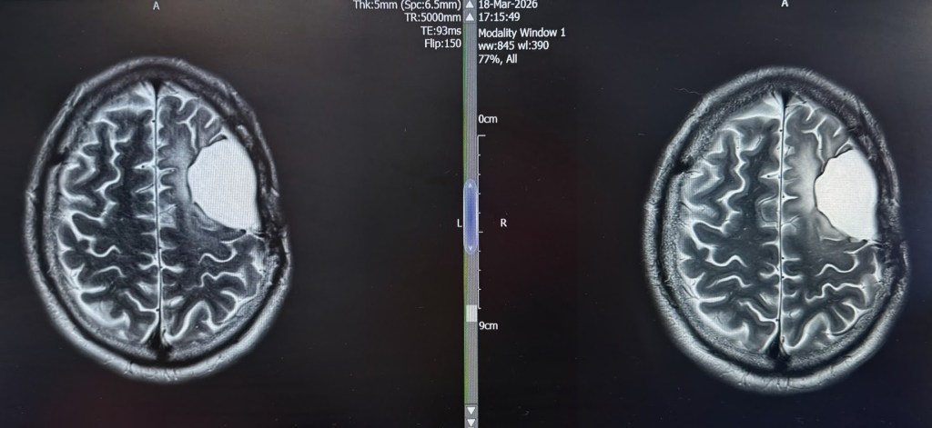 A side-by-side MRI scan of a brain, showing detailed images of the cerebral hemispheres, with prominent gyri and sulci.